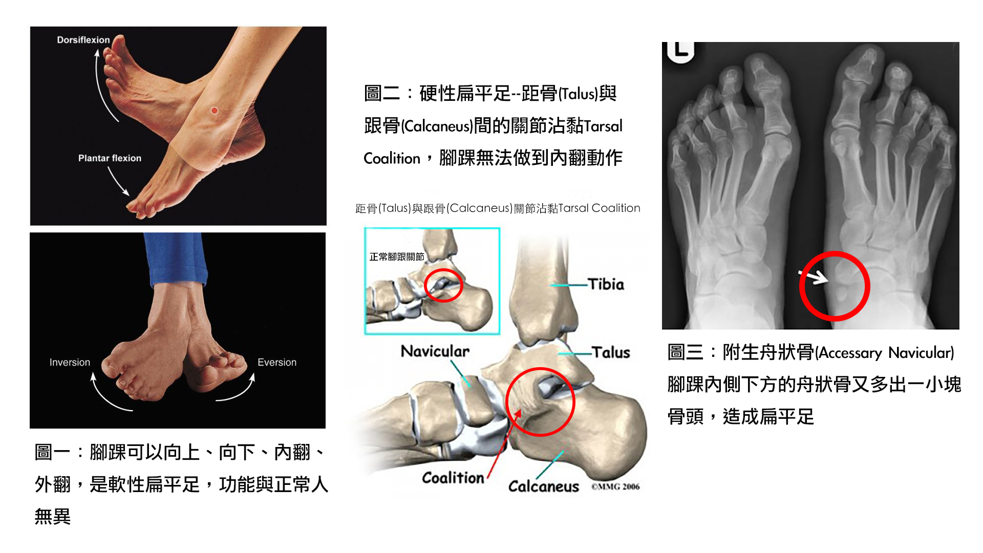 穿矯正鞋 足弓墊治療扁平足 這件事被誇大了 福雅骨科 家庭醫學科診所