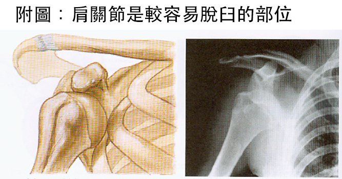 脫臼可能直接徒手復位嗎 福雅骨科 家庭醫學科診所